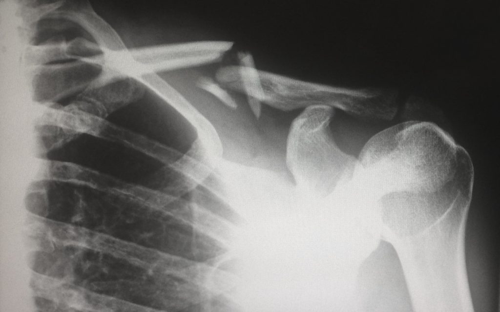 An xray image to symbolise the topic of the blog which is preventing workplace accidents