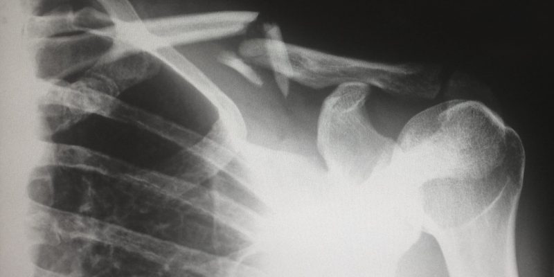 An xray image to symbolise the topic of the blog which is preventing workplace accidents